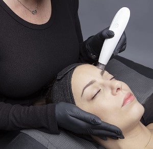 Microdermabrasion oder Microneedling bei Aknenarben